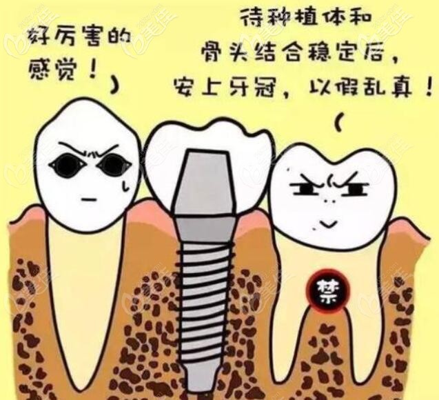 种植牙 种植牙