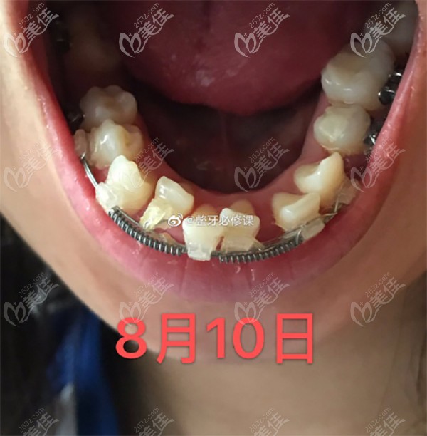 在达康口腔戴陶瓷半隐形牙套的牙齿