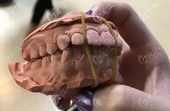 戴牙套可以改善骨性凸嘴吗 戴牙套可以改善骨性凸嘴吗