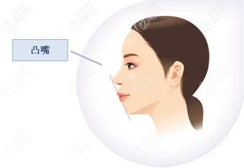 骨性凸嘴戴牙套有用吗? 骨性凸嘴戴牙套有用吗?