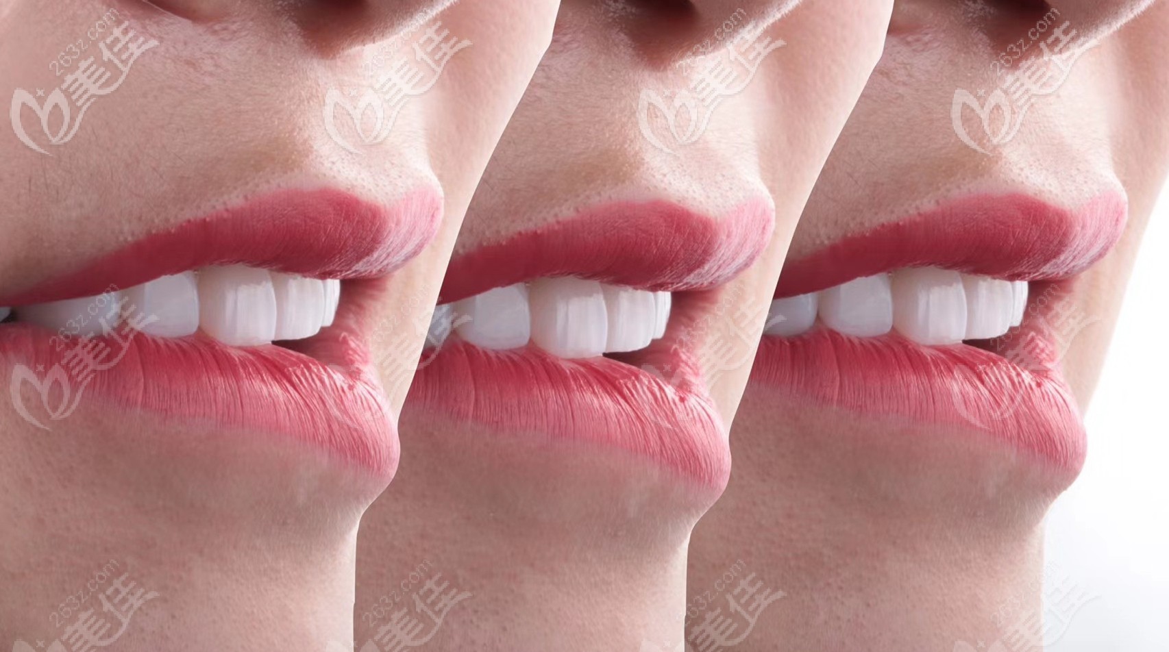 柳州华山口腔的超薄瓷贴面牙齿修复案例