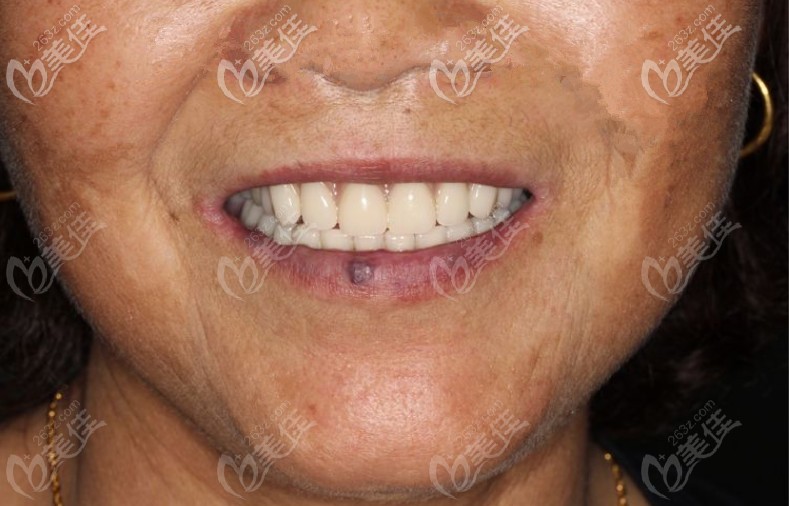 这是张奶奶在长治恒伦口腔做满口bps吸附性义齿的效果