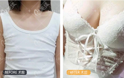 花6万多找北京新星靓李伟民做的点对点脂肪隆胸效果 花6万多找北京新星靓李伟民做的点对点脂肪隆胸效果