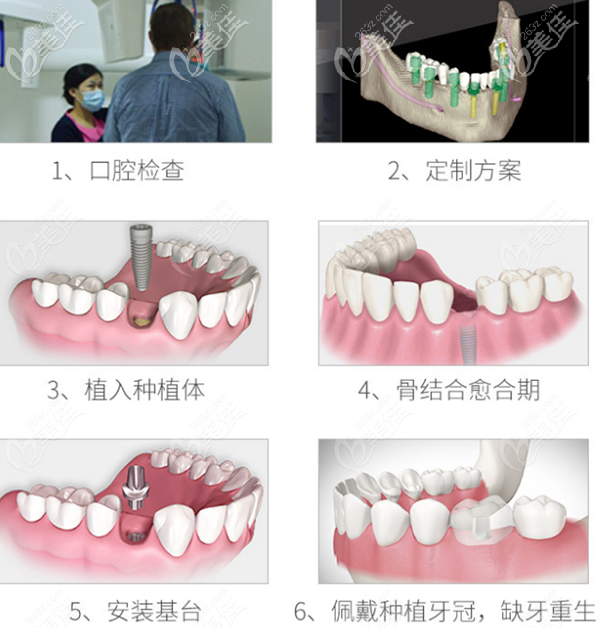 深圳光美种植牙过程
