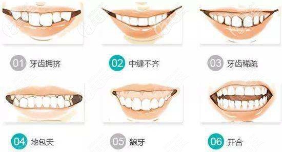 牙齿矫正可以改善的牙齿类型