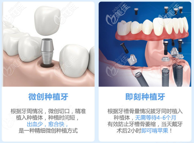 上海美冠口腔种植牙技术优势