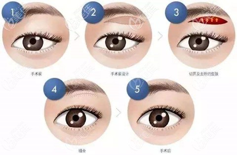 三层筋膜提美手术过程 三层筋膜提美手术过程