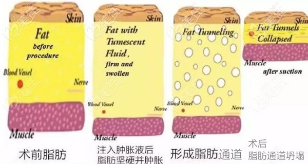 吸脂手术注射肿胀液的原因 吸脂手术注射肿胀液的原因