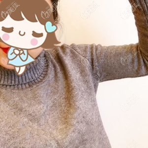 手臂吸脂术后20天肿胀渐消效果明显 手臂吸脂术后20天肿胀渐消效果明显