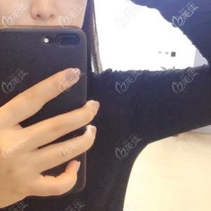 选择做水动力手臂吸脂的原因是，能避免出现皮肤褶皱