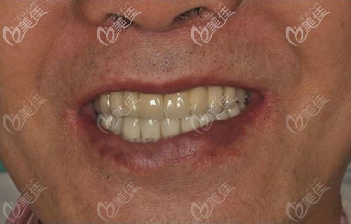 南充美昂口腔全口种植牙后的效果