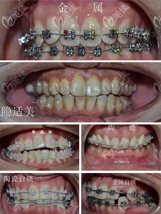 陶瓷自锁,金属自锁,隐形牙套区别示意图