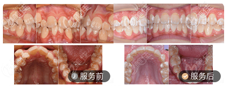 上海美冠口腔龅牙牙齿矫正案例