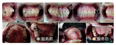 上海美冠口腔虎牙牙齿矫正案例