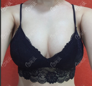 分享一则在韩国德新整形医院做自体脂肪隆胸的案例