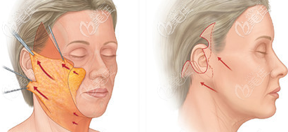 柳京翰面部提升手术的示意图