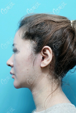 拆线后的侧面照