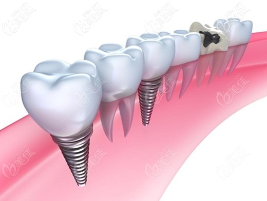 陈青龙医生科普不同品牌种植体的特色 陈青龙医生科普不同品牌种植体的特色