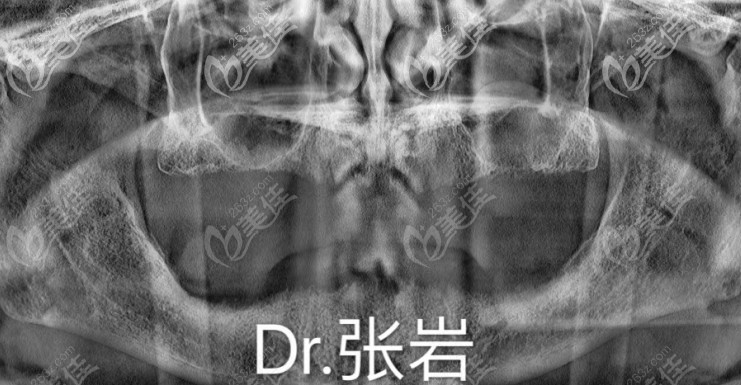 满口牙缺失未种植前的CT片 满口牙缺失未种植前的CT片