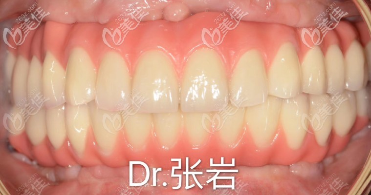 allon6种植牙效果图 allon6种植牙效果图