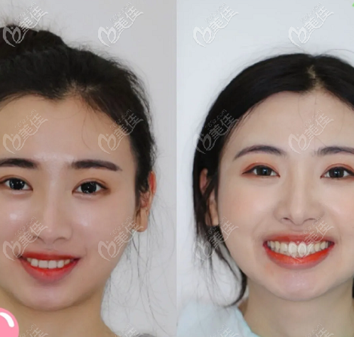 去年三月在北京壹加壹口腔做时代天使隐形矫正花了16800元,感觉很靠谱 去年三月在北京壹加壹口腔做时代天使隐形矫正花了16800元,感觉很靠谱