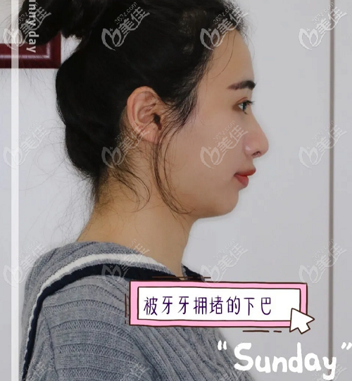 在北京壹加壹口腔做正畸之前的照片 在北京壹加壹口腔做正畸之前的照片