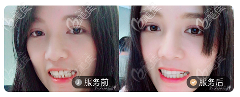 北京壹加壹口腔正畸案例对比图