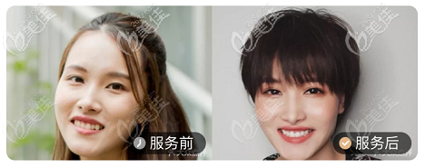 北京壹加壹口腔隐适美隐形牙齿矫正案例