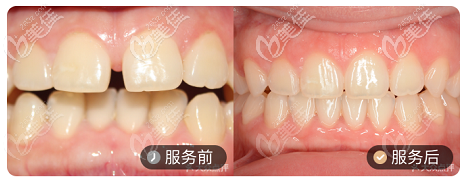 北京壹加壹口腔隐适美隐形矫正案例