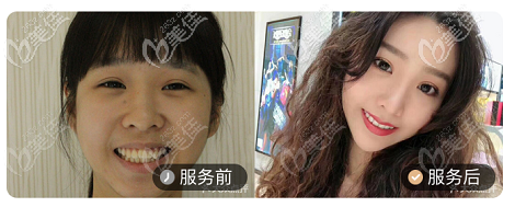 北京壹加壹口腔龅牙矫正案例