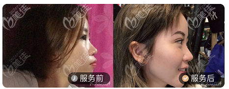 北京壹加壹口腔陶瓷半隐形牙齿矫正案例