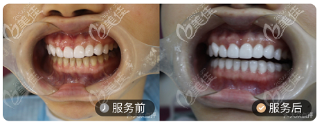 北京壹加壹牙科超薄瓷贴面案例对比图