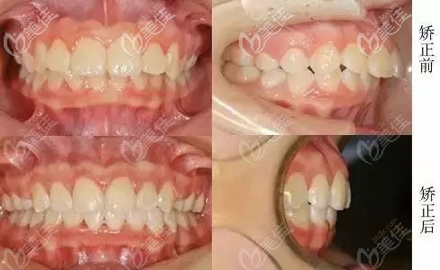 上颌前突，下牙拥挤的龅牙问题在悦牙口腔做时代天使隐形标准版矫正，1年半就改善了