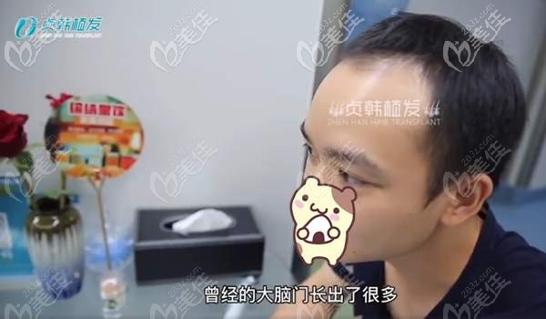 植发前前额脱发明显 植发前前额脱发明显