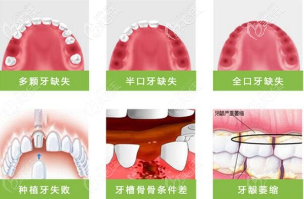 种植牙适合的种植人群 种植牙适合的种植人群