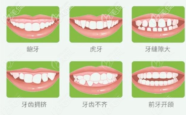 适合做隐形矫正的人群 适合做隐形矫正的人群