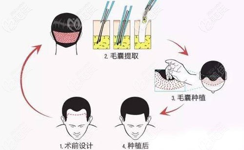 吴医生做发际线移植手术原理 吴医生做发际线移植手术原理