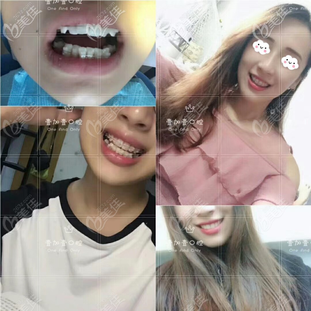 广州壹加壹半隐形陶瓷矫正案例对比图 广州壹加壹半隐形陶瓷矫正案例对比图
