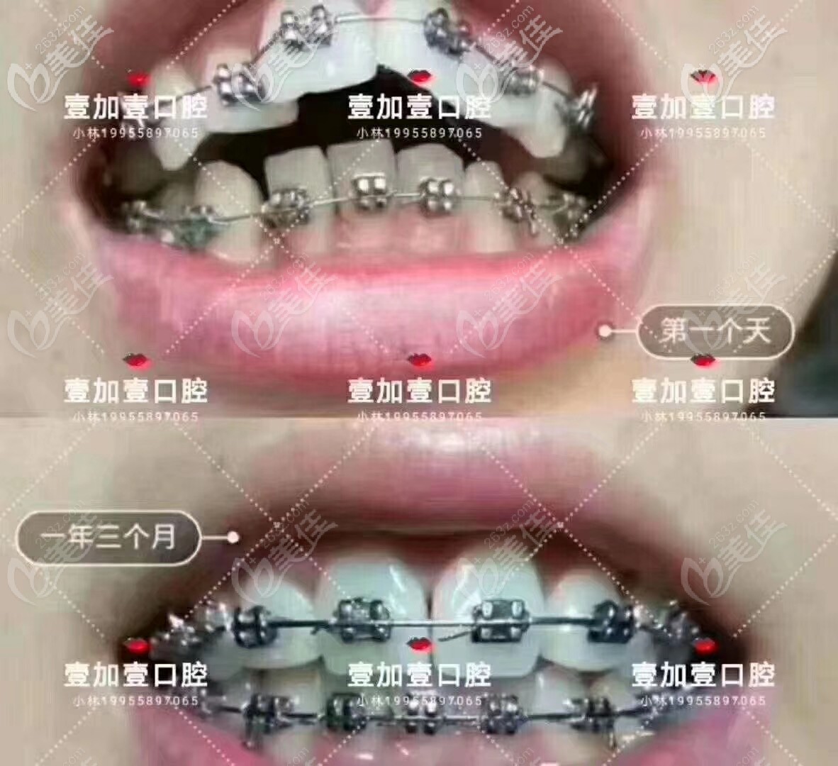 真人案例了解广州壹加壹金属托槽矫正怎么样? 真人案例了解广州壹加壹金属托槽矫正怎么样?