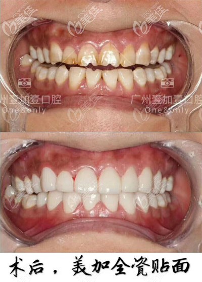 广州壹加壹美加全瓷牙贴面案例对比图 广州壹加壹美加全瓷牙贴面案例对比图