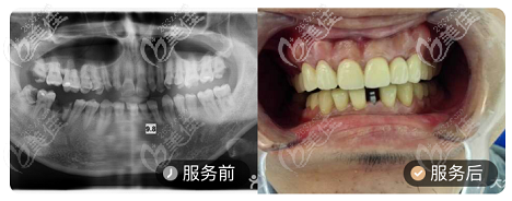 深圳赛亚齿科确实不错,我的牙周炎牙缺失就是在陈义庭口腔修复好的