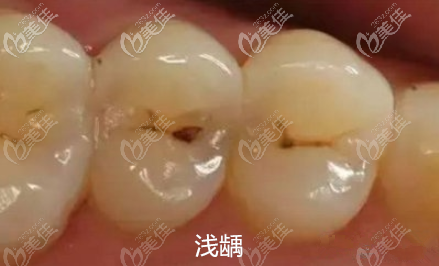 浅龋图
