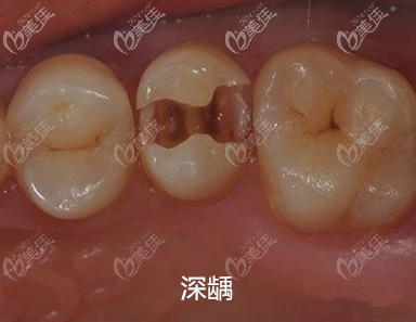 深龋图