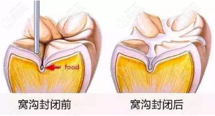 窝沟封闭治疗前后对比