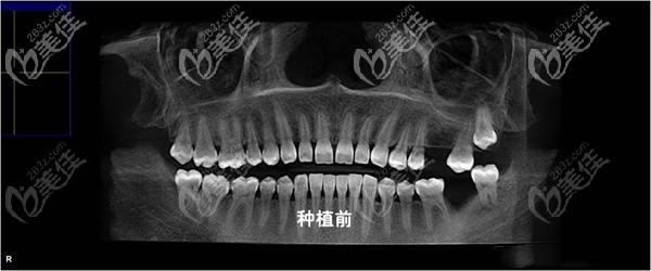 做种植牙之前的照片 做种植牙之前的照片
