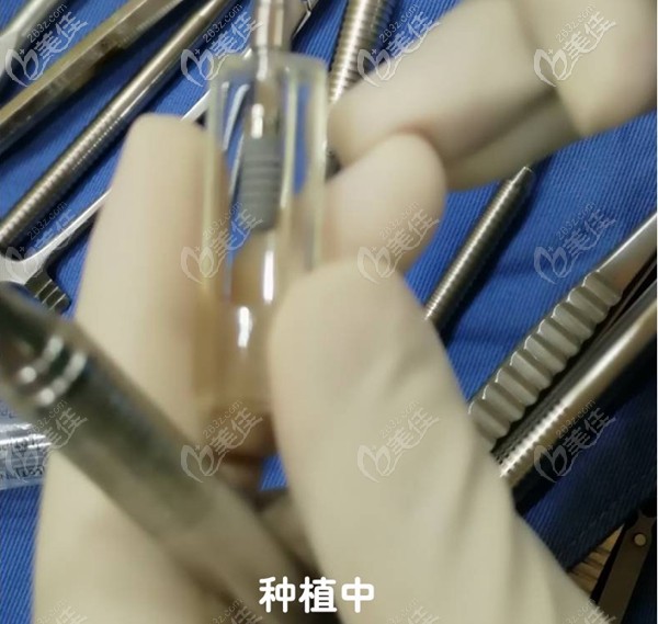 做瑞士ITI种植牙过程 做瑞士ITI种植牙过程