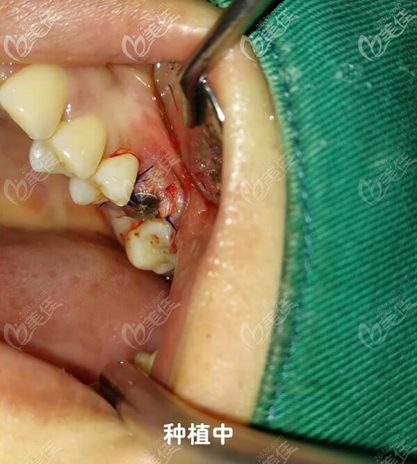 做瑞士ITI种植牙手术中 做瑞士ITI种植牙手术中