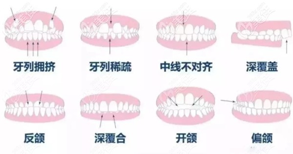 可以做牙齿矫正的牙齿类型