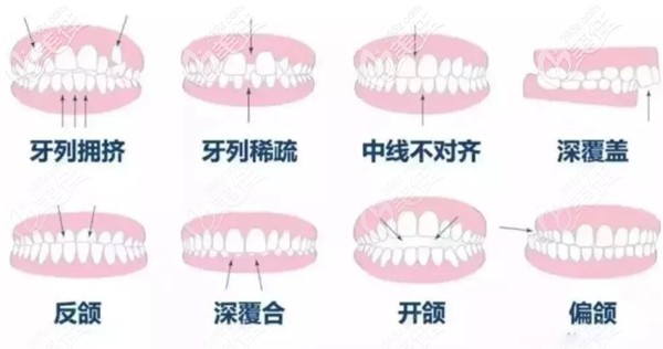 可以做牙齿矫正的牙齿类型