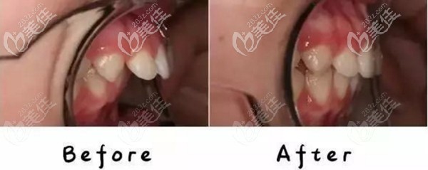 在深圳光美口腔做隐形矫正一年效果